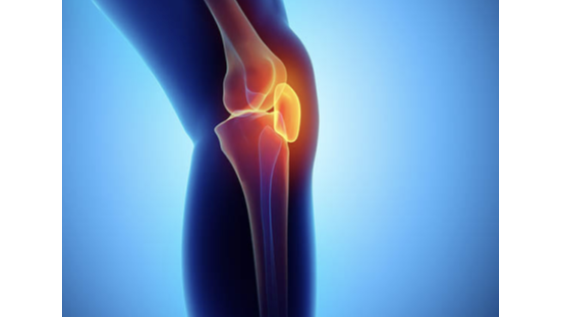 Pre-op CBT to Reduce the Risk for Development of Chronic Post-surgical Pain in Patients Undergoing Total Knee Arthroplasty
