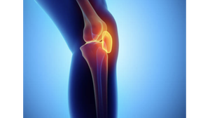  Pre-op CBT to Reduce the Risk for Development of Chronic Post-surgical Pain in Patients Undergoing Total Knee Arthroplasty 