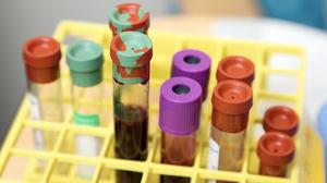  Study Evaluating Safety and Efficacy of UCART123 in Patients With Relapsed/ Refractory Acute Myeloid Leukemia (AMELI-01) 